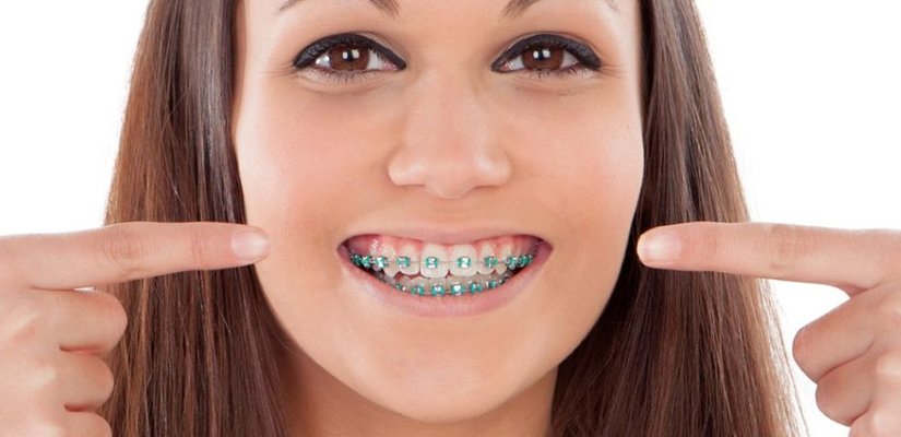 Aparelho Dentário