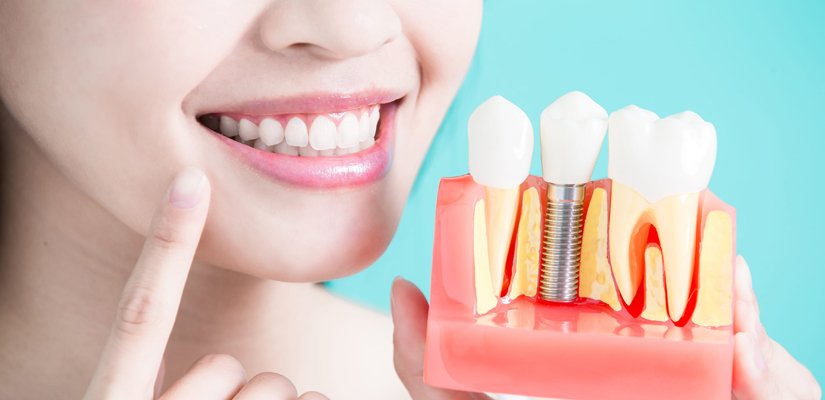 Implantes Dentários